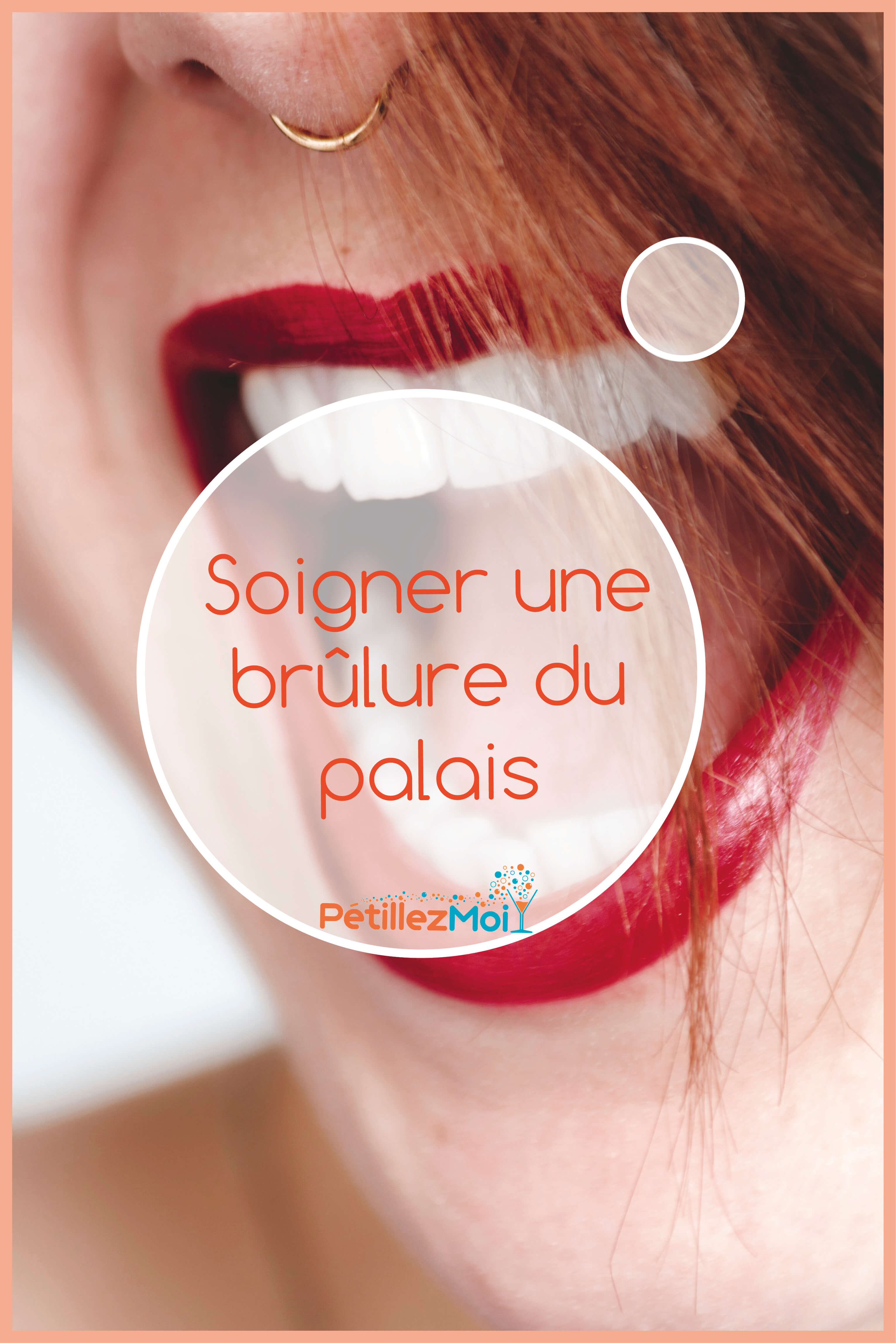 soigner brûlure du palais